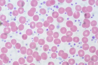 Essential_Thrombocythemia_Peripheral_Blood_(10189570483)